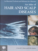 An atlas of hair and scalp diseases